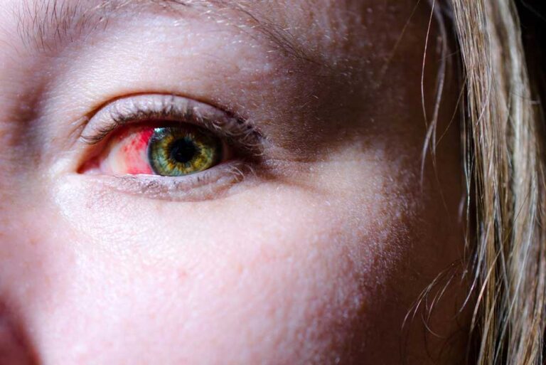 A red or bloodshot eye can be a sign of impairment. Drug and alcohol education can help employees, supervisors, and managers identify signs that one of their colleagues could be under the influence.